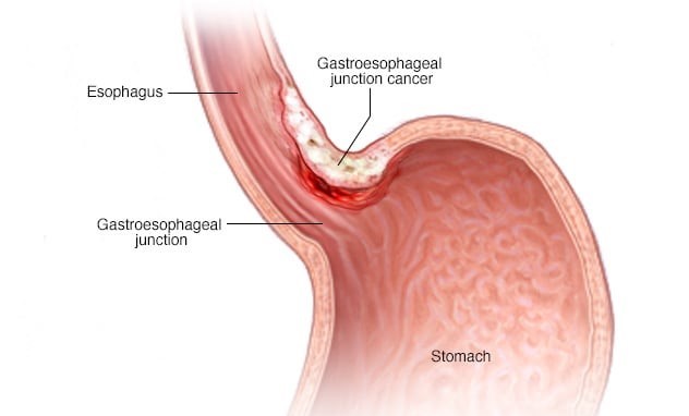 stomach-cancer
