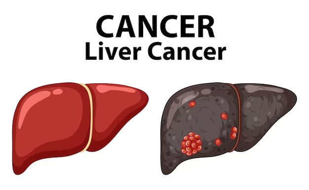 Liver Cancer: A Comprehensive Guide to Understanding the Disease