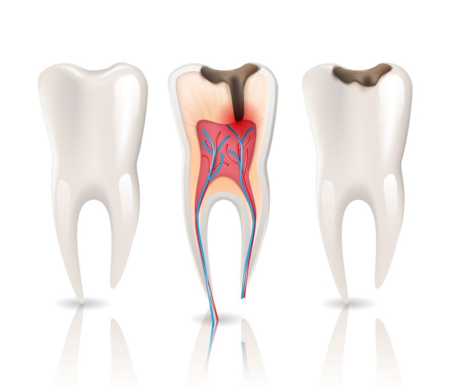 Dental Caries: Causes, Symptoms, Prevention, and Treatment