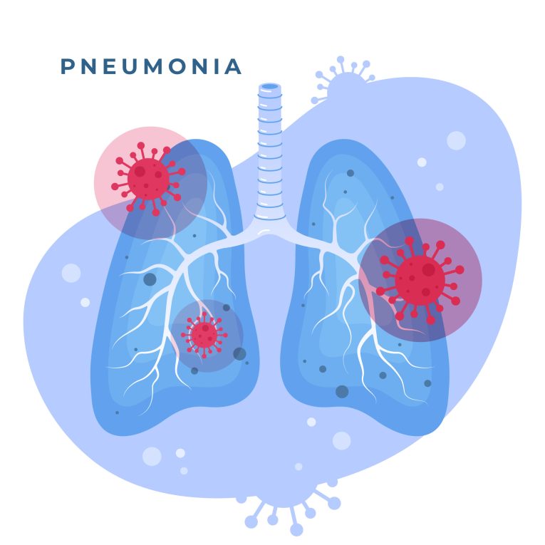 pneumonia