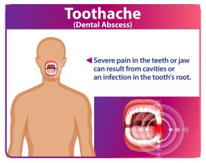 Dental Caries Symptoms: