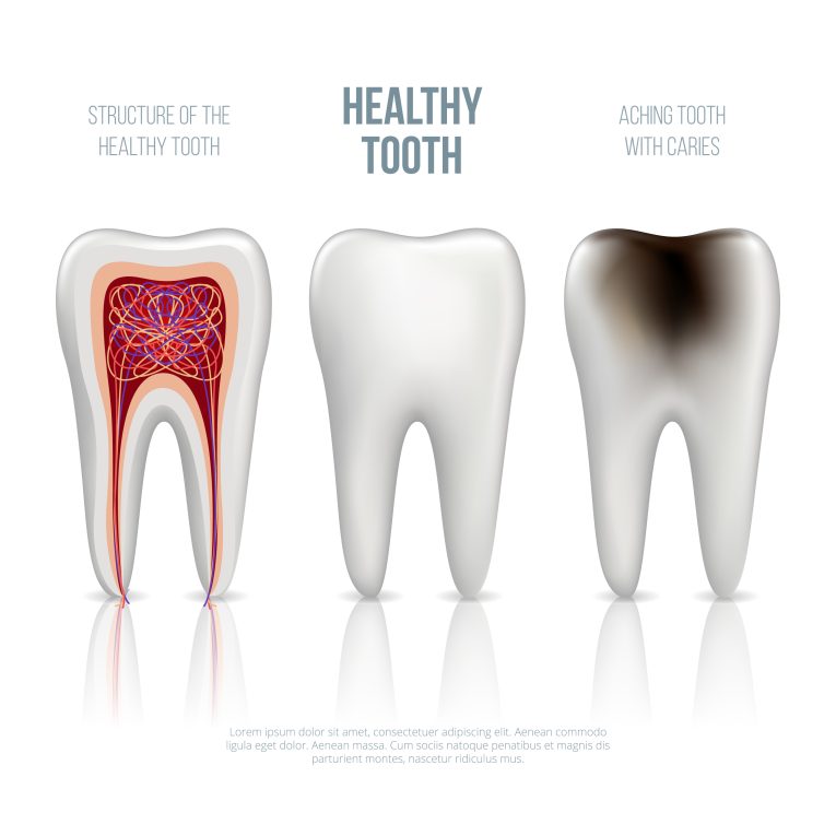 Understanding Dental Caries: Causes, Symptoms, Prevention, and Treatment