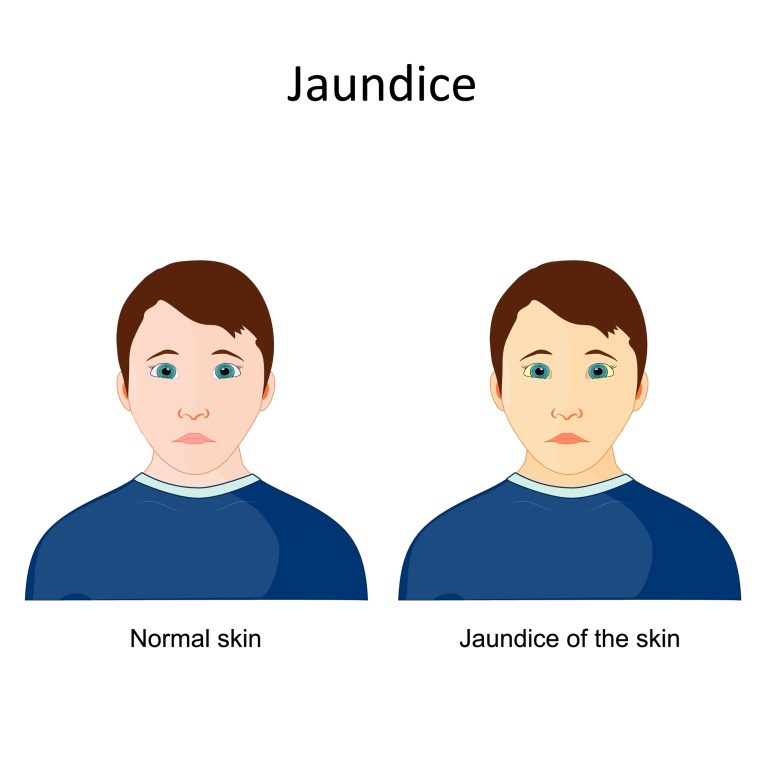 jaundice