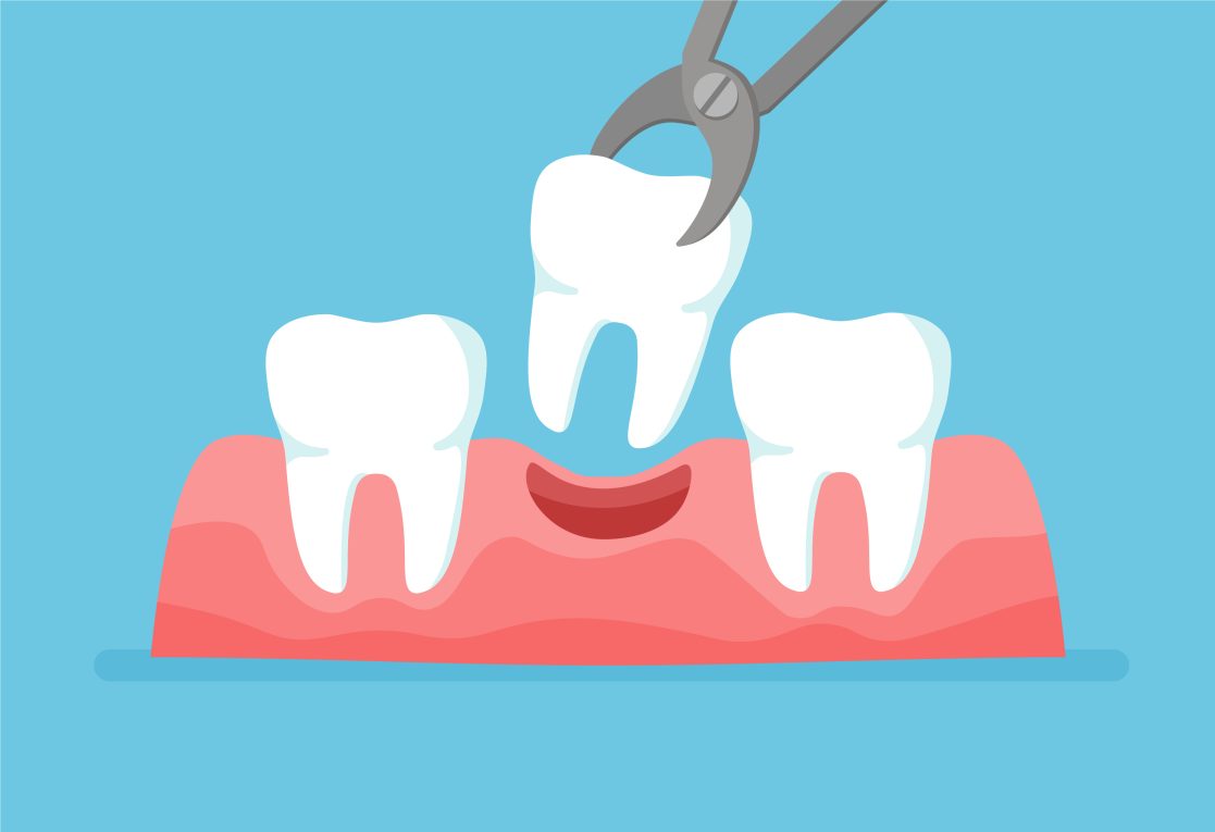 tooth extraction