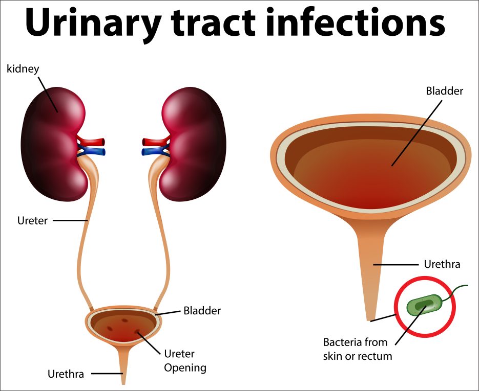 Urinary Tract Infections (UTIs): Causes, Symptoms, Prevention, and Treatment