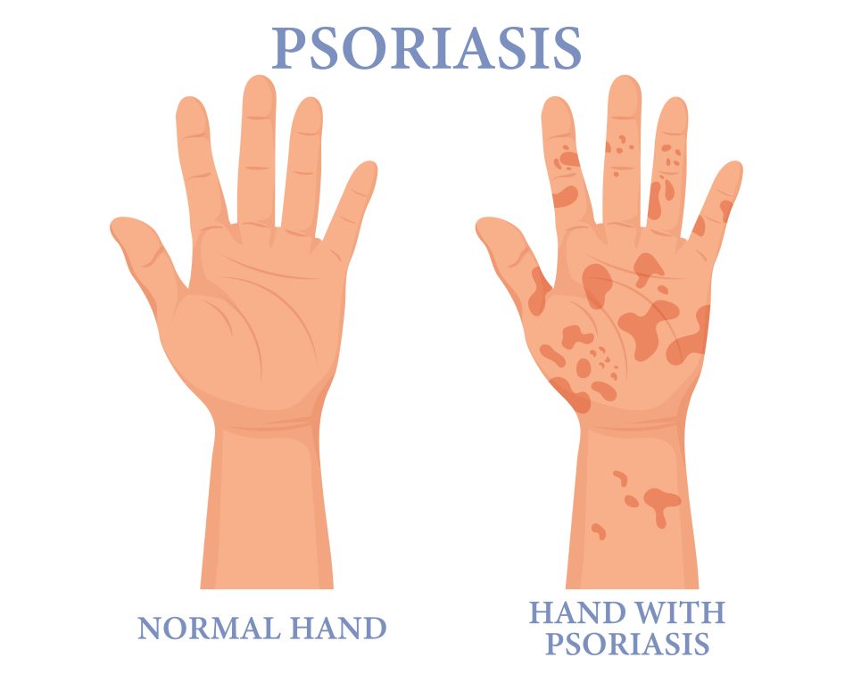 Understanding Psoriasis: Symptoms, Causes, and Treatment Options