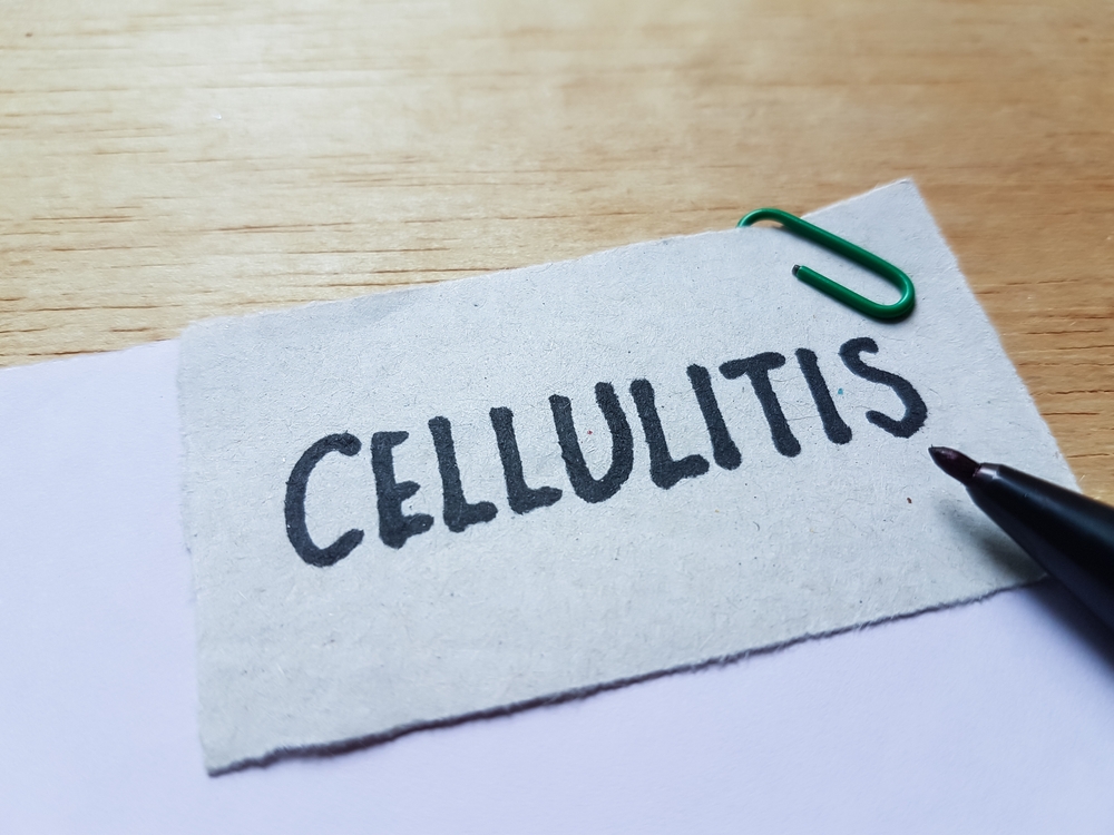 Exploring Cellulitis: 10 Vital Points for Better Understanding and Prevention