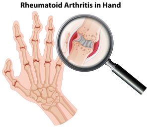 Rheumatoid arthritis (RA)