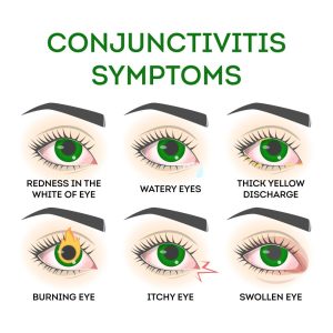 Conjunctivitis Symptoms