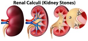 kidney stones