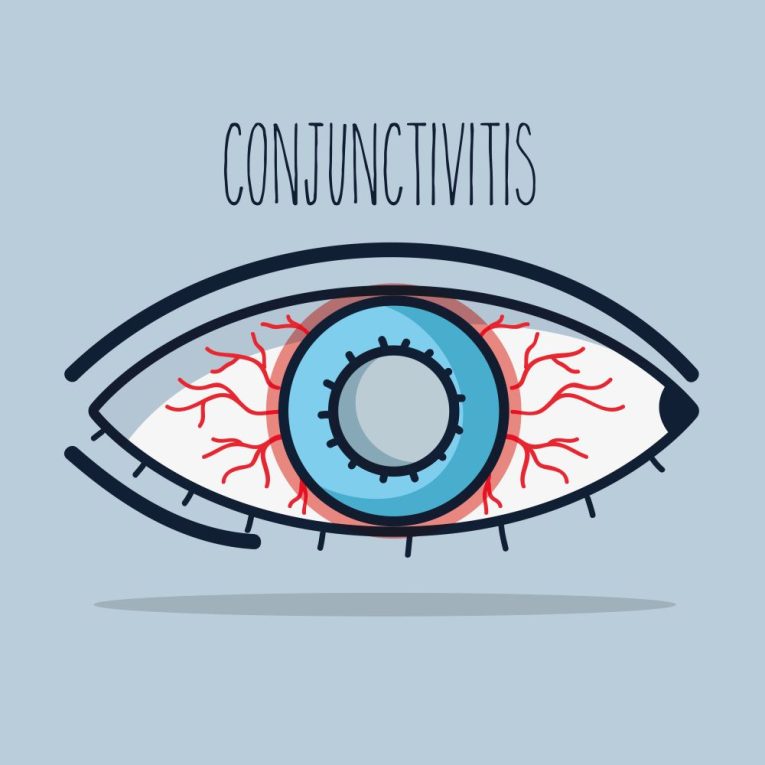 conjunctivitis