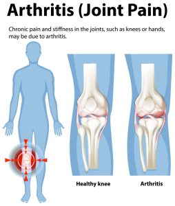 Arthritis pain