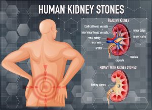 kidney stones