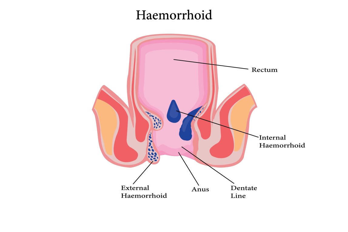 Haemorrhoids Explained: What You Need to Know for Better Health Management