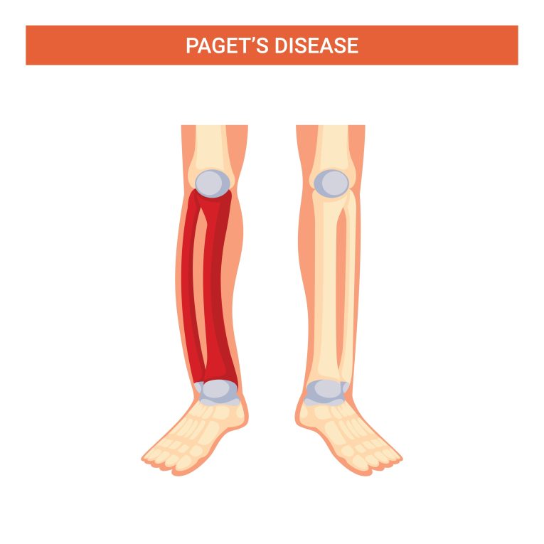 Navigating Paget’s Disease of Bone: An In-Depth Look at Its Impact and Care Strategies