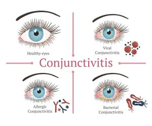 Types of Conjunctivitis