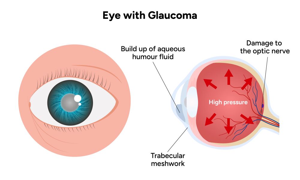 Glaucoma Awareness Month: Raising Awareness for a Silent Vision Thief