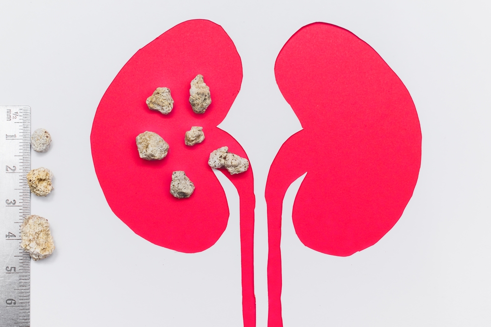 Kidney Stones Explained: Things to Know for Better Health