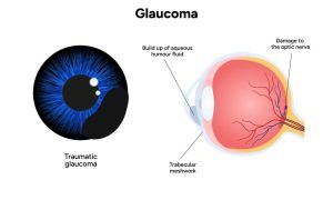 Glaucoma