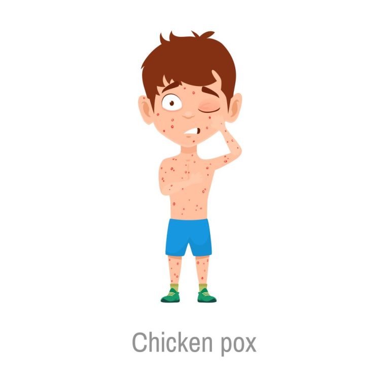 Chickenpox Explained: How to Recognize, Treat, and Prevent This Disease