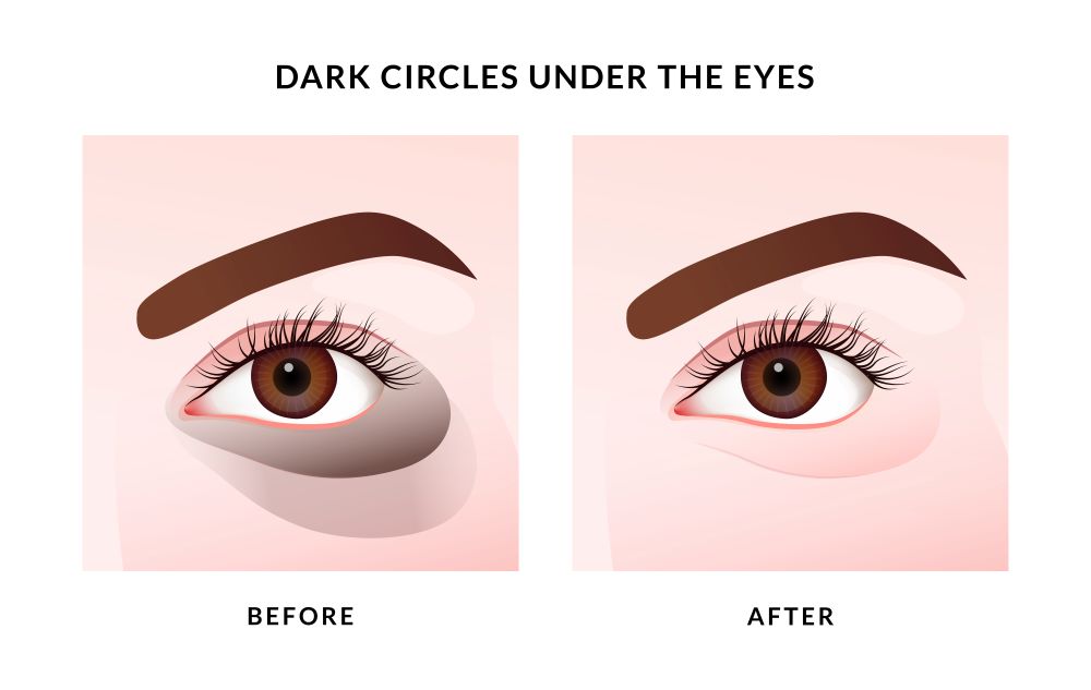 Dark Circles? Try These Proven Remedies for Brighter Eyes