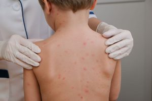 Chickenpox symptoms