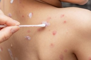 Chickenpox treatment